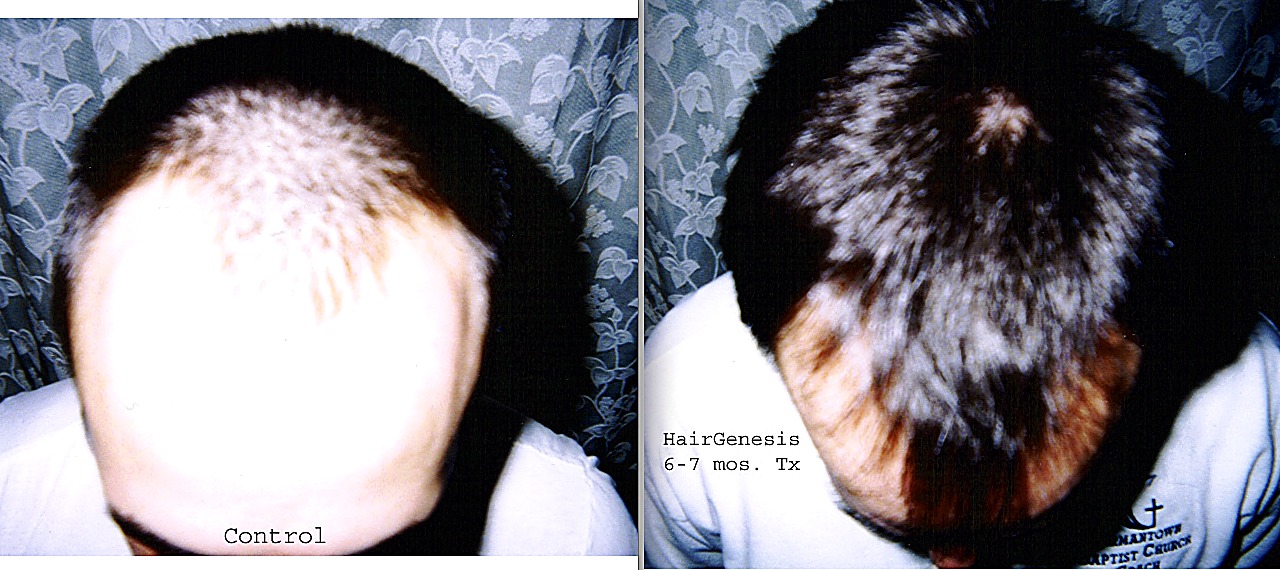 Male · Vertex — Control vs. 6–7 mo. Treatment