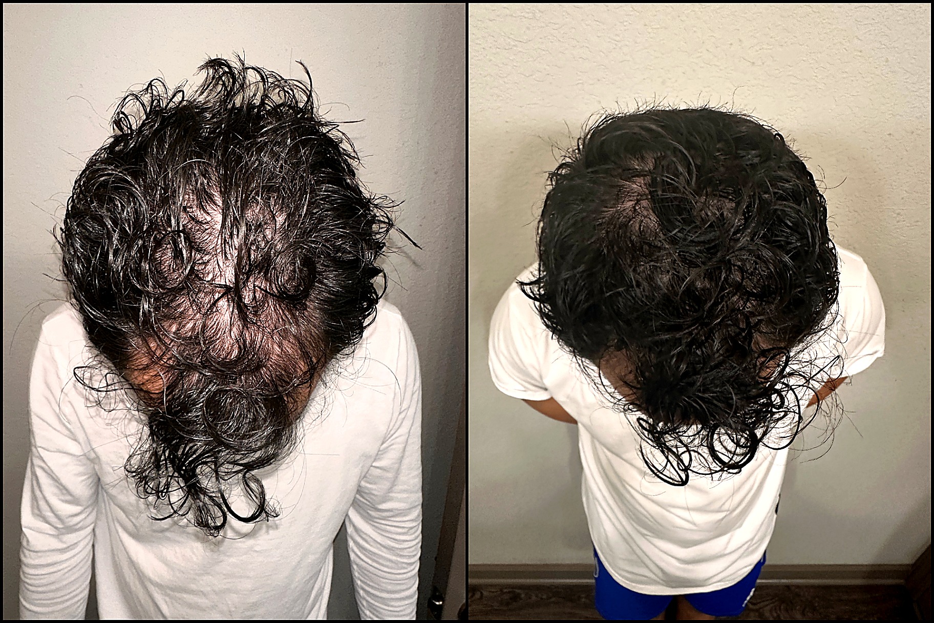 Male · Diffuse Crown — Day 0 → Day 90
