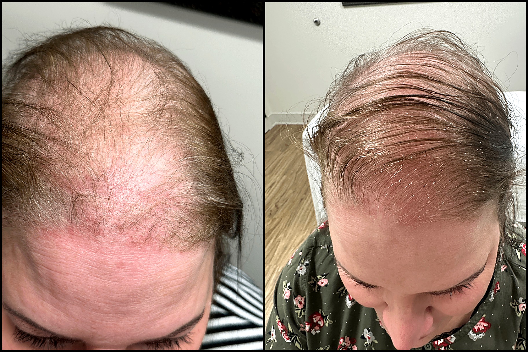 Female · Frontal Density — Day 0 → Day 90